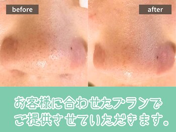 キザシ(kizashi)/最新毛穴ケア☆即実感！毛穴縮小