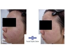 フェイシャルスタイリストサロン 高崎店(Facial Stylist Salon)/ケア例（86）