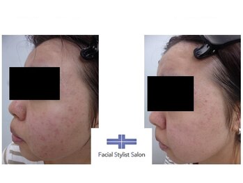 フェイシャルスタイリストサロン 高崎店(Facial Stylist Salon)/ケア例(86)