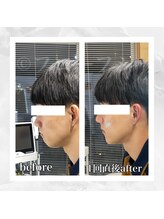 フローフシ∞/【小顔】20代男性症例写真