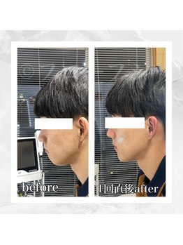 フローフシ∞/【小顔】20代男性症例写真
