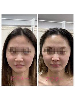 ジェルベーラ(GERBERA)/予約殺到!GERBER小顔矯正術!