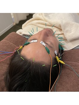 蒼月(aotsuki)/電気を流す美容鍼