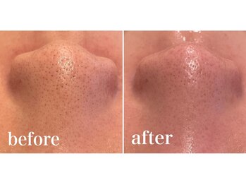 リム(Lim:)/ハイドロ毛穴洗浄◆小顔エステ