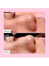 ホワイトラボ 天王寺(White labo)/【施術例】ハイドロフェイシャル