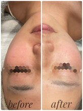 ニコリ(Nicori)/光フェイシャル