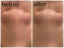 エヌインスキンケアスタジオ 天神店 N-inスキンケアスタジオ/症例【美肌/美白/小顔/毛穴】