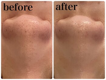 エヌインスキンケアスタジオ 天神店 N-inスキンケアスタジオ/症例【美肌/美白/小顔/毛穴】