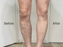 アクアセルフ 南仙台駅前店/業務用の最新脱毛機スピード脱毛