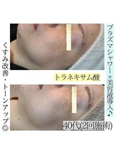 アースコアフュールボーテ ひたち野うしく店(EARTH coiffure beaute)/プラズマシャワーでトーンアップ