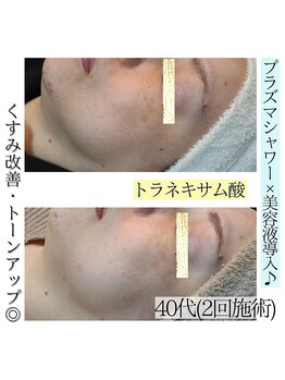 アースコアフュールボーテ ひたち野うしく店(EARTH coiffure beaute)/プラズマシャワーでトーンアップ
