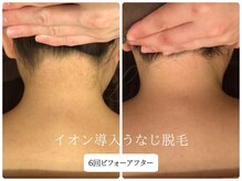 リノ(Lino)/うなじ脱毛シェービング付き♪