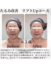 ミヤビ(MIYABI)/１回の施術結果