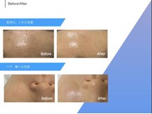 ユラン(YURAN)/第4世代ピーリング！