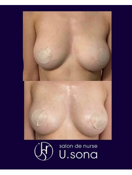 小顔・脂肪コントロール専門 salon de nurse U.sona～松本店～/【バストケア】脂肪増殖10cc
