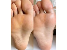 キラネイル アンド アイラッシュ by World Beauty(KIRA)/#新潟巻爪　#ペディグラス