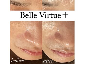 ベルバーチュプラス(Belle Virtue +)/カーボキシー