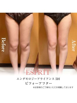 エスプリ 新宿店/痩身エステ新宿・エンダモロジー
