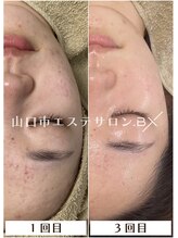ビーエックス(.BX)/ハーブピーリング Before/After