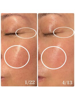 楚々(SOSO)/3回目の効果