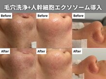 イーラボ 池袋店(e-LABO)の雰囲気（直後の1回の効果！黒ずみ・毛穴汚れ解消【毛穴洗浄./肌質改善】）