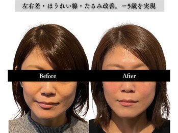 アロエベル(aloe Belle)/Before After（4回施術）