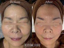 ライフサロン 天神(Life Salon)/美容鍼Before /After◎