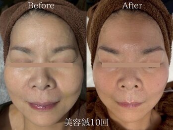 ライフサロン 天神(Life Salon)/美容鍼Before /After◎