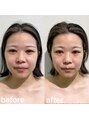リニューサロン 本院(renew salon)&nbsp;小顔矯正もお任せ下さい♪