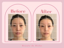 ボーテドリッシュ(Beaute de Riche)/小顔矯正beforeafter