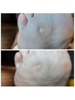 爪切り屋 足楽/1か月後にもリバウンドせず