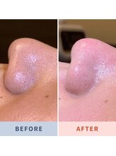 ソリス ビューティー(SOLIS BEAUTY)/毛穴洗浄