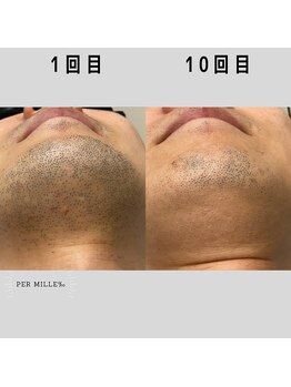 パーミル(per mille‰)/Before/After