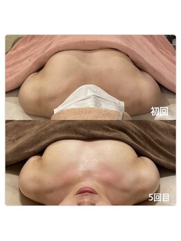 ベッピン(Beppin)/バストアップ／筋膜リリース