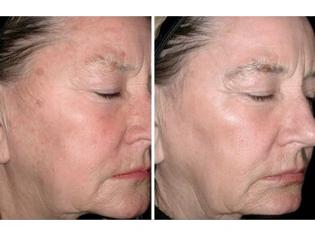 エヌ スタイル(N Style)/肌質改善&リフトアップ