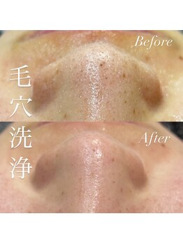 アース コアフュールボーテ 新潟紫竹山店(EARTH coiffure beaute)/毛穴洗浄