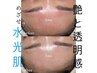 【赤み】究極の敏感肌へ★REVI角質ケア+エメ水肌ポレ+モデリングパック
