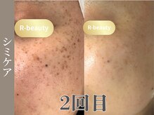 アールビューティー(R-beauty)/蓄積系の深い悩みも徐々に薄く