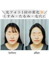 キュララ(KYURARA)/【光フォト1回の効果】