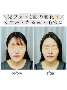 キュララ(KYURARA)/【光フォト1回の効果】