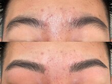 アンベリール(Embellir)/眉毛beforeafter