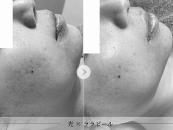 スパレーカ(Spa laka)/凹凸・色むらケア