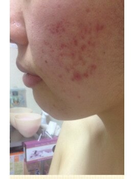 スキンケアスタジオ アコ 新宿店(Aco)/GP５Dほほポツポツのお客様