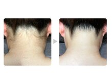 カレン 沖縄小禄店/脱毛結果２　えり足（うなじ）