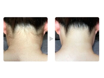 カレン 沖縄小禄店/脱毛結果２　えり足（うなじ）