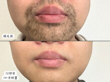 セルフメイド 東大阪店(SELFMADE)/髭脱毛♪ヒゲ剃り負けなし！！