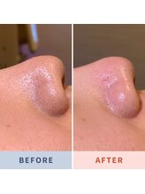 ソリス ビューティー(SOLIS BEAUTY)/毛穴洗浄