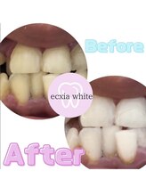 エクシアホワイトニング 静岡駅前店/ビフォーアフター