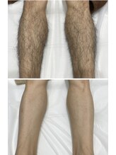 セブンボーテ(7Beaut'e)/メンズ脚脱毛♪