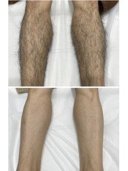 セブンボーテ(7Beaut'e)/メンズ脚脱毛♪